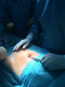 Підготовка до постановки троакара при операції TEP при паховій грижі