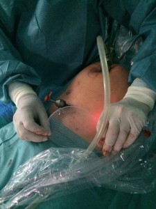 Примірювання сітчастого імплантата при операції ТЕР при паховій грижі