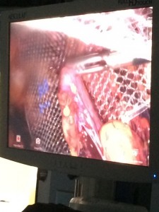 постановка сітчастого імплантата під час операції ТЕР